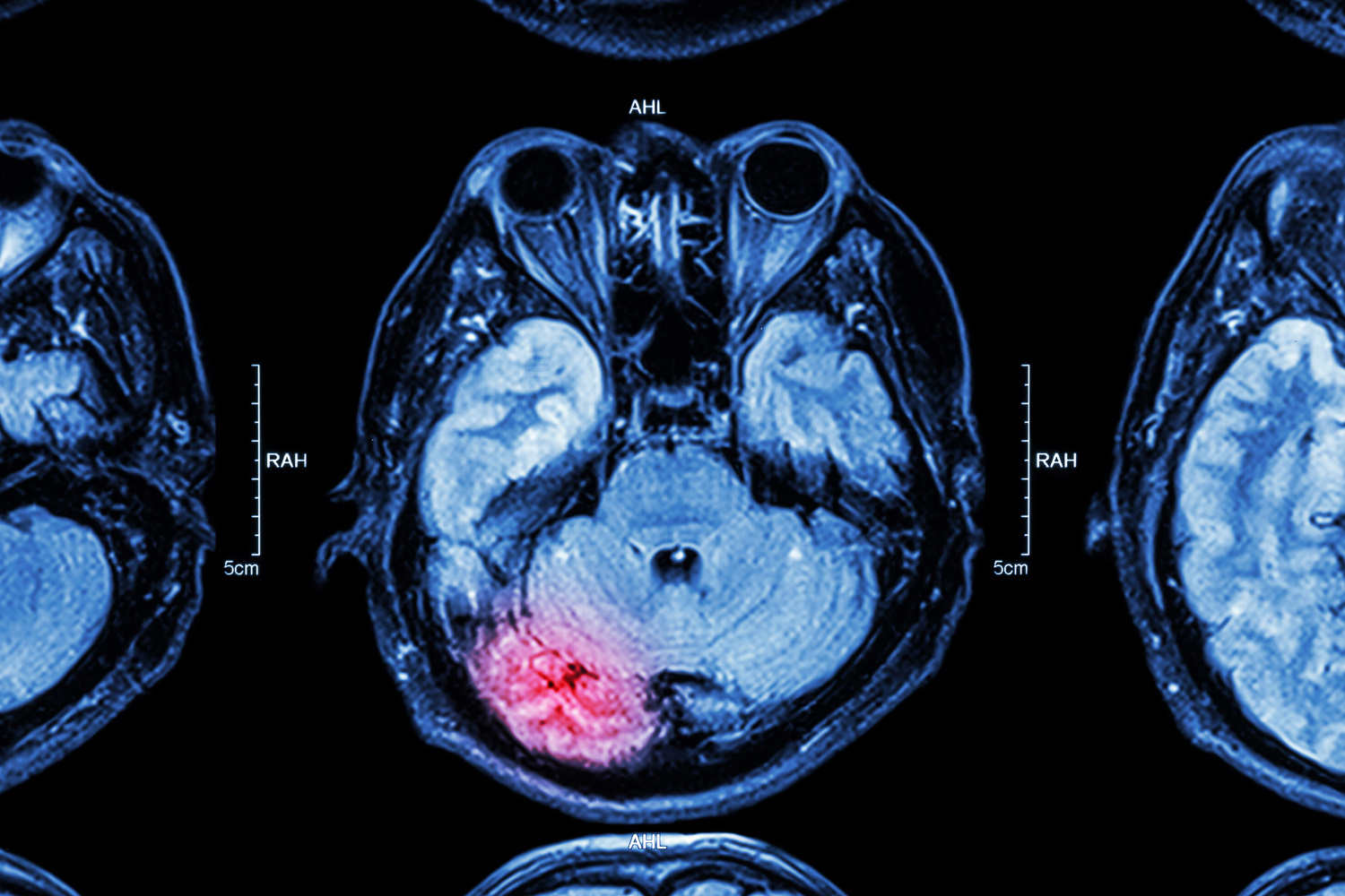 MRI of brain : brain injury MRI of brain : brain injury